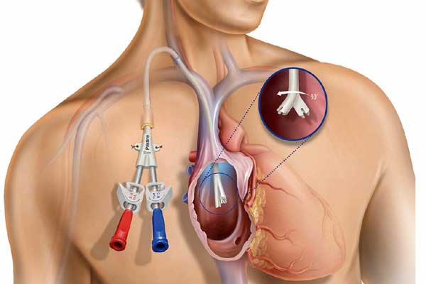 consentdialysis catheter